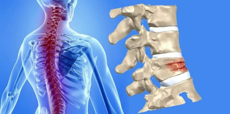 Kebiasaan yang Bisa Merusak Struktur Tulang Belakang