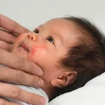 Ruam di Leher Bayi: Penyebab hingga Cara Menanganinya Ruam di Leher Bayi: Penyebab hingga Cara Menanganinya