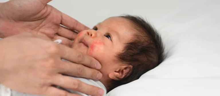 Ruam di Leher Bayi: Penyebab hingga Cara Menanganinya