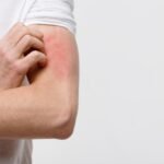 Mengenal Alergi Kulit : Penyebab, Gejala, dan Solusi Efektif Mengenal Alergi Kulit : Penyebab, Gejala, dan Solusi Efektif